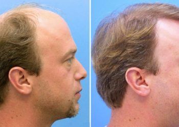 Migliori cliniche per trapianto di capelli in Italia