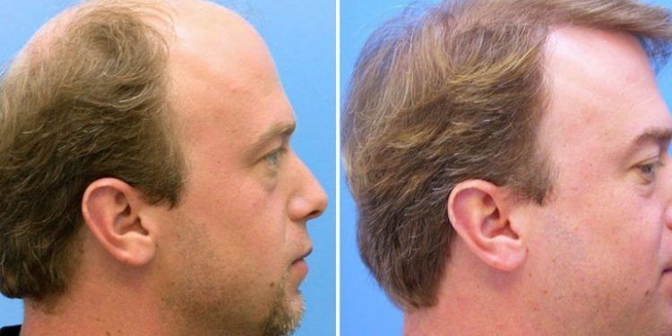 Migliori cliniche per trapianto di capelli in Italia