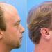Migliori cliniche per trapianto di capelli in Italia