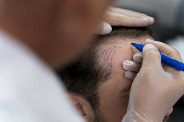medico che sta calcolando il quali sezioni del cuoio capelluto svolgerà il trapianto