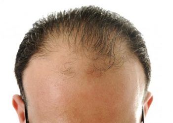 Calvo a meno di 30 anni: cosa posso fare?