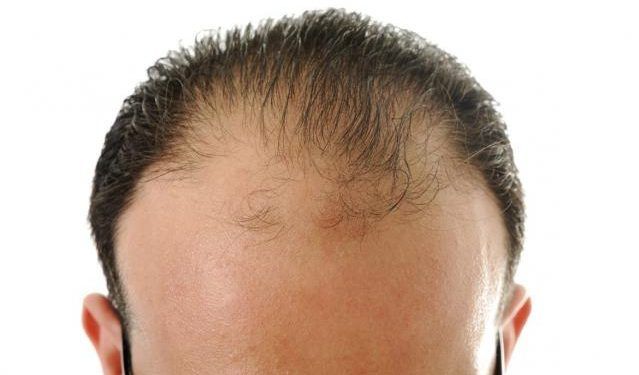 Calvo a meno di 30 anni: cosa posso fare?