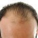 Calvo a meno di 30 anni: cosa posso fare?