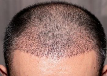 Quali sono le cause della caduta dei capelli negli uomini?