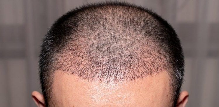 Quali sono le cause della caduta dei capelli negli uomini?
