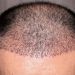 Quali sono le cause della caduta dei capelli negli uomini?