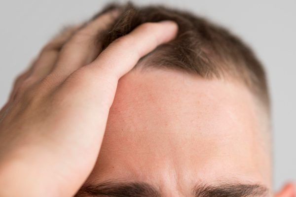 La perdita di capelli.
