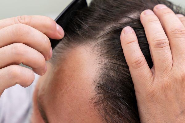 Uomo con capelli rigenerati.