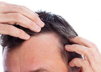 Dermatite seborroica e caduta dei capelli