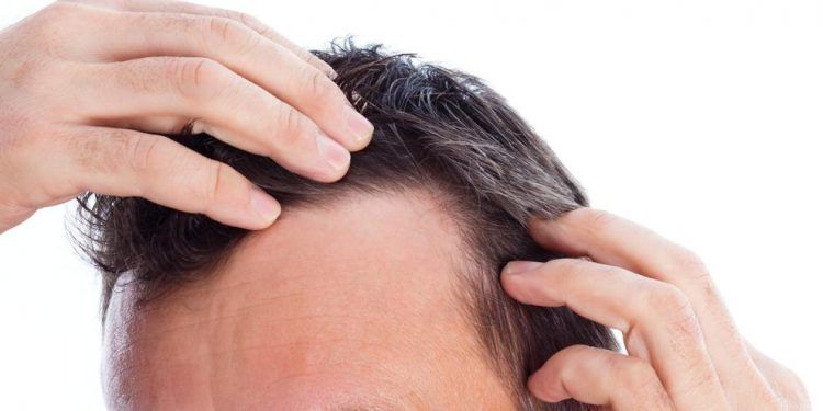 Dermatite seborroica e caduta dei capelli
