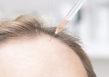 Com'è un trapianto di capelli nella zona frontale