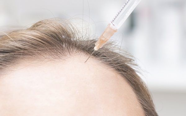 Com'è un trapianto di capelli nella zona frontale