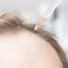 Com'è un trapianto di capelli nella zona frontale