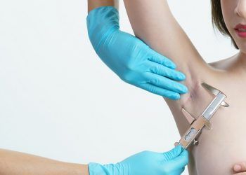 Cheloidi, cosa sono e come rimuoverle?