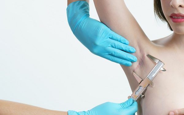 Cheloidi, cosa sono e come rimuoverle?