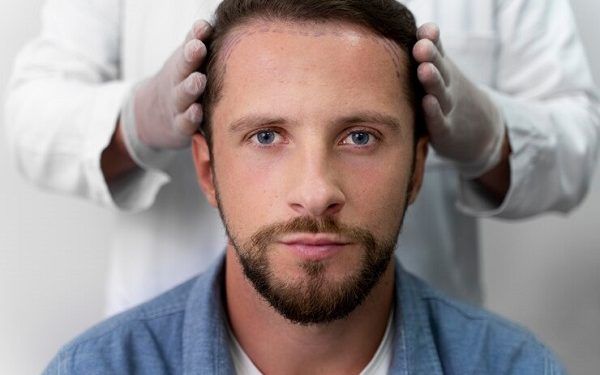I capelli dell'area donatrice ricrescono dopo un trapianto?