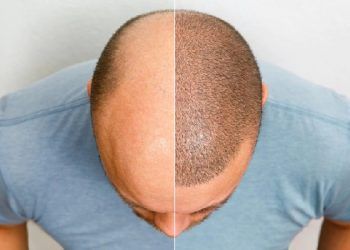 Puoi donare i capelli a qualcun altro?