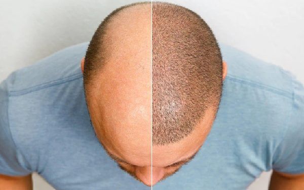 Puoi donare i capelli a qualcun altro?