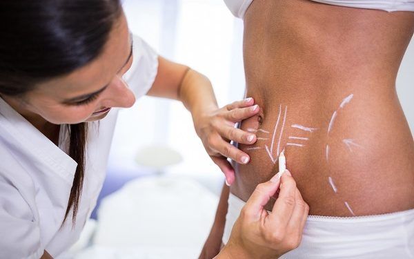 Liposcultura e liposuzione: quali sono le differenze?
