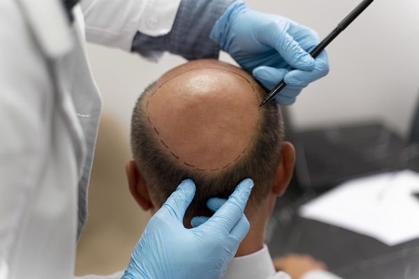 capelli ricrescono dopo trapianto di capelli