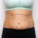 Cos’è il lipofilling e per chi è indicato?