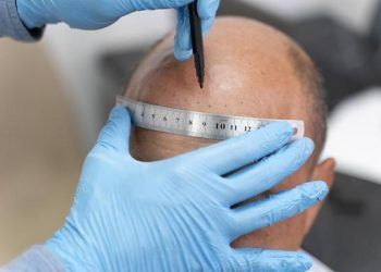 Come affrontare il periodo di recupero dopo un trapianto di capelli?