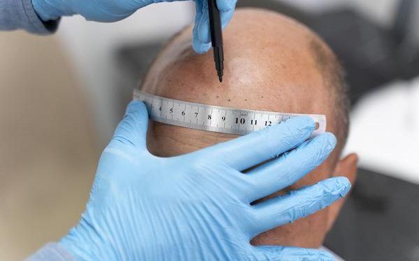 Come affrontare il periodo di recupero dopo un trapianto di capelli?