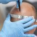 Come affrontare il periodo di recupero dopo un trapianto di capelli?