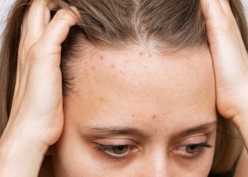 Cos’è l’acne del cuoio capelluto?