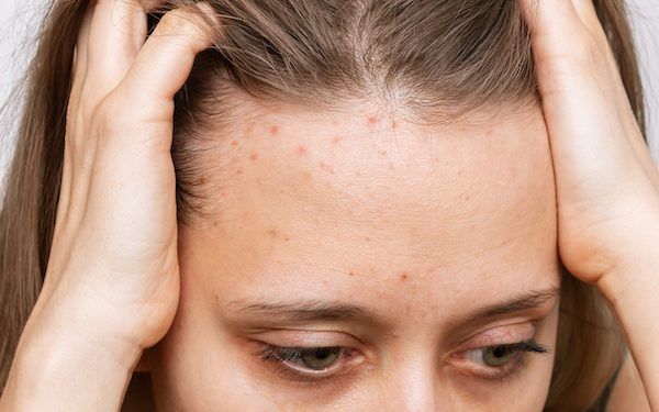 Cos’è l’acne del cuoio capelluto?