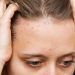 Cos’è l’acne del cuoio capelluto?