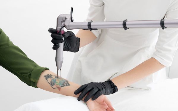 Le 10 migliori cliniche per rimuovere tatuaggi a Milano