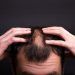 infiammazioni caduta di capelli
