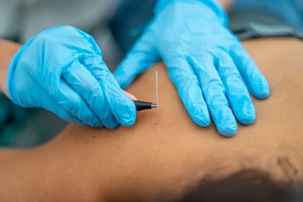 Fotografia di un medico che prende un ago da agopuntura con il cordone.