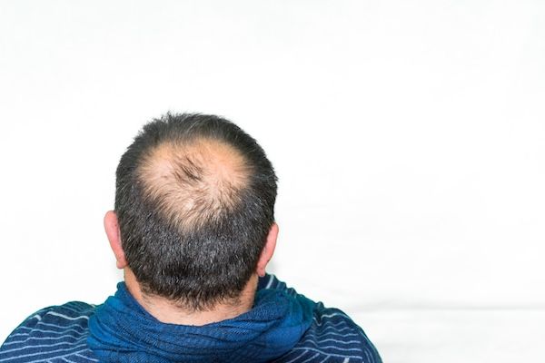 Primo piano di un uomo con l'attaccatura dei capelli sfuggente su uno sfondo bianco