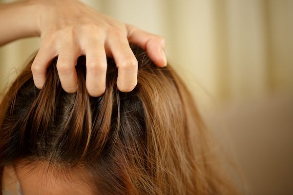 Una donna ha problemi con i capelli e il cuoio capelluto, ha la forfora a causa di reazioni allergiche agli shampoo. e balsamo per capelli