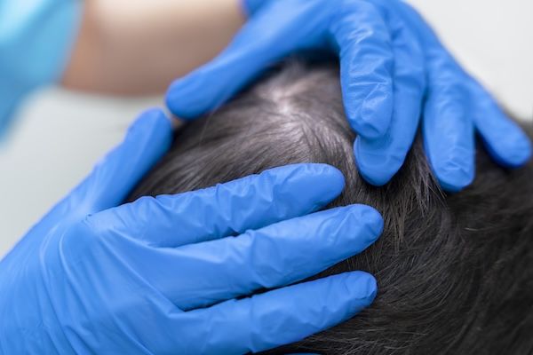 Maschio adulto che riceve un trattamento per la caduta dei capelli