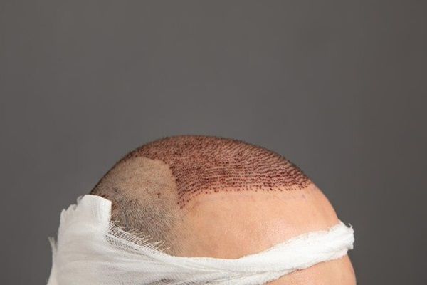 Uomo caucasico dopo il trapianto di capelli