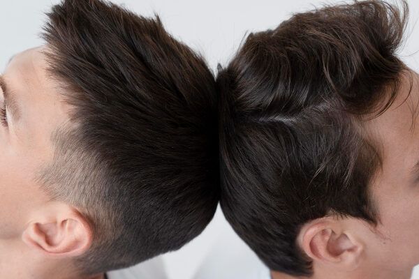 Evoluzione dopo un trapianto di capelli.