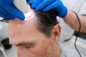 uomo-che-riceve-il-trattamento-per-la-caduta-dei-capelli
