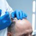 Descrizione-dettagliata-del-processo-di-trapianto-di-capelli-in-Turchia