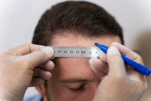 maschio adulto che fa l'estrazione dell'unità follicolare