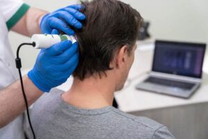 uomo che riceve un trattamento per la caduta dei capelli sulla parte posteriore della testa
